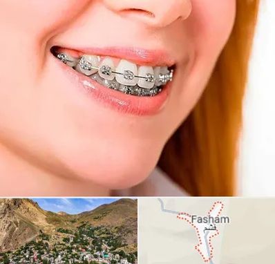 ارتودنسی ارزان در فشم