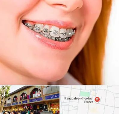 ارتودنسی ارزان در 15 خرداد