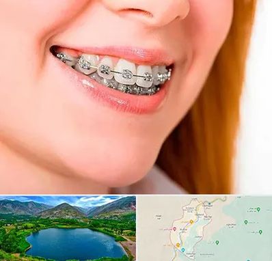 ارتودنسی ارزان در رودبار