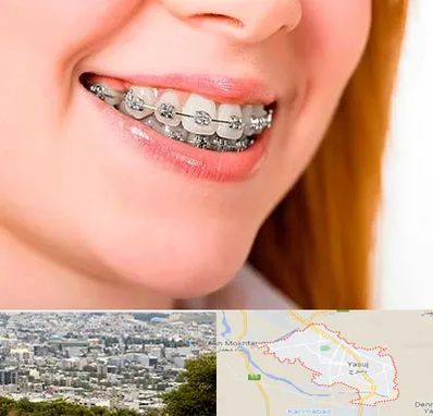 ارتودنسی ارزان در یاسوج