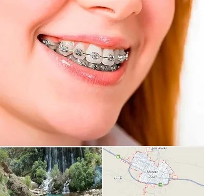 ارتودنسی ارزان در شیروان