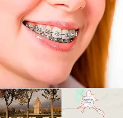 ارتودنسی ارزان در تویسرکان
