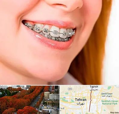 ارتودنسی ارزان در ولیعصر 