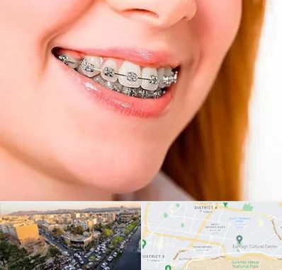 ارتودنسی ارزان در تهرانپارس 