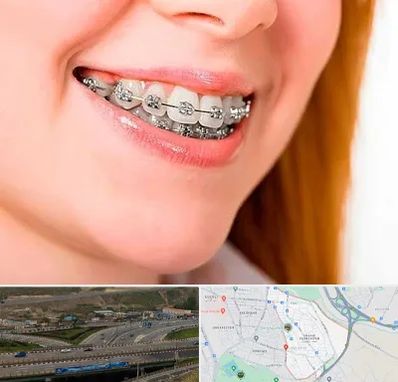 ارتودنسی ارزان در یاغچیان تبریز