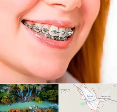 ارتودنسی ارزان در دورود