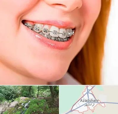 ارتودنسی ارزان در آزادشهر