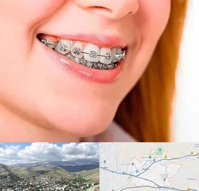 ارتودنسی ارزان در رودهن