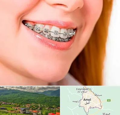 ارتودنسی ارزان در آمل