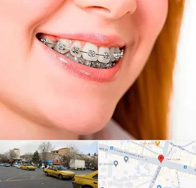 ارتودنسی ارزان در شهناز تبریز