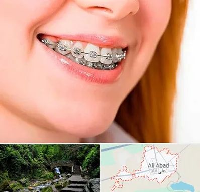 ارتودنسی ارزان در علی آباد کتول