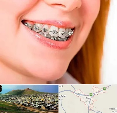 ارتودنسی ارزان در بیجار