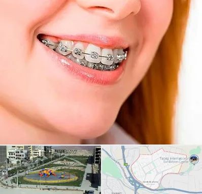 ارتودنسی ارزان در مرزداران تبریز