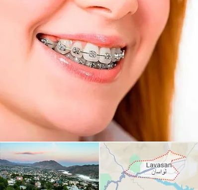 ارتودنسی ارزان در لواسان