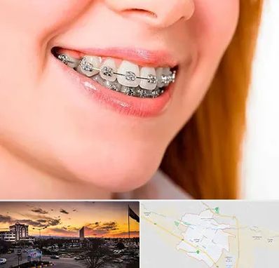 ارتودنسی ارزان در قوچان