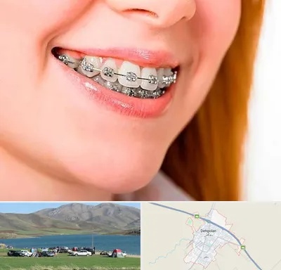 ارتودنسی ارزان در دهگلان