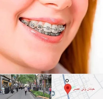 ارتودنسی ارزان در ولیعصر شهریار