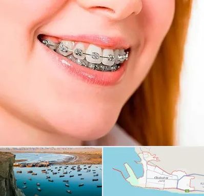 ارتودنسی ارزان در چابهار