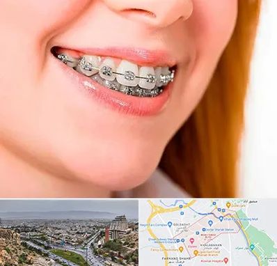 ارتودنسی ارزان در معالی آباد شیراز 