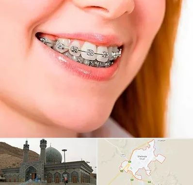 ارتودنسی ارزان در شهرضا