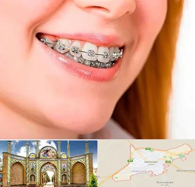 ارتودنسی ارزان در سمنان