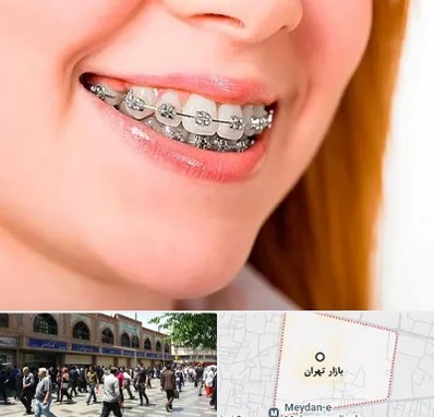 ارتودنسی ارزان در بازار تهران
