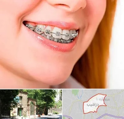 ارتودنسی ارزان در دزاشیب
