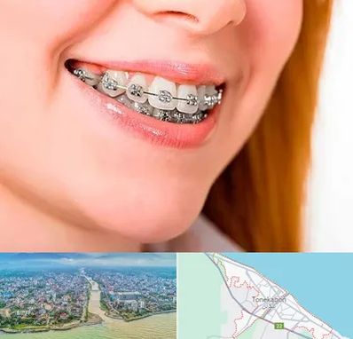 ارتودنسی ارزان در تنکابن