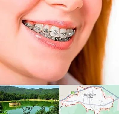 ارتودنسی ارزان در بهشهر