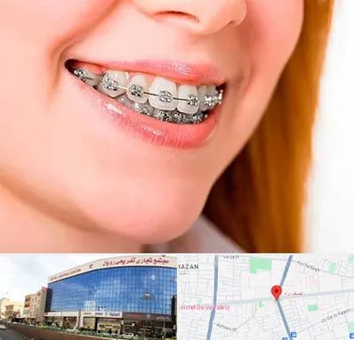 ارتودنسی ارزان در نصف راه تبریز