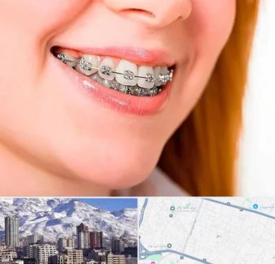 ارتودنسی ارزان در ازگل