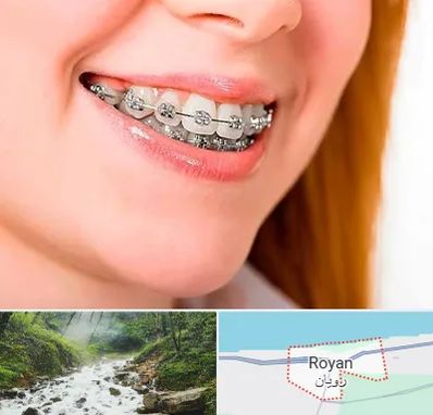 ارتودنسی ارزان در رویان