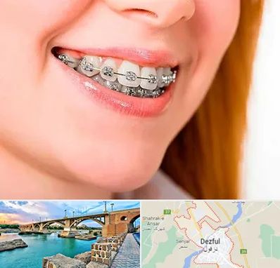 ارتودنسی ارزان در دزفول