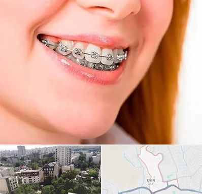 ارتودنسی ارزان در اوین
