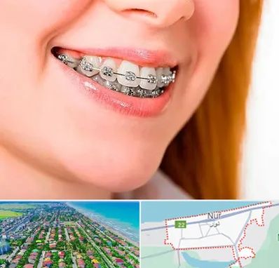 ارتودنسی ارزان در نور