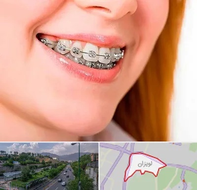ارتودنسی ارزان در لویزان