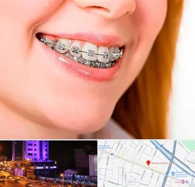 ارتودنسی ارزان در آبرسان تبریز