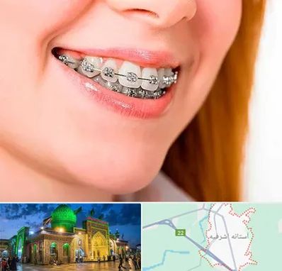 ارتودنسی ارزان در آستانه اشرفیه