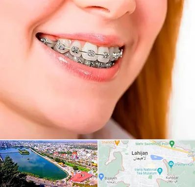 ارتودنسی ارزان در لاهیجان