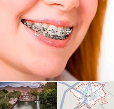 ارتودنسی ارزان در دامغان