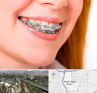 ارتودنسی ارزان در عباس آباد تهران
