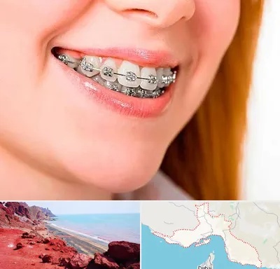 ارتودنسی ارزان در هرمزگان