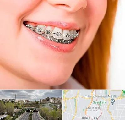 ارتودنسی ارزان در یوسف آباد 