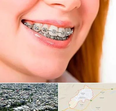 ارتودنسی ارزان در شاهرود