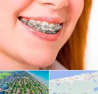 ارتودنسی ارزان در فریدونکنار