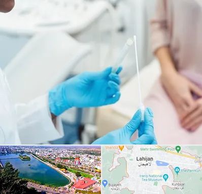 دکتر زگیل تناسلی HPV در لاهیجان