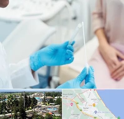 دکتر زگیل تناسلی HPV در رودسر