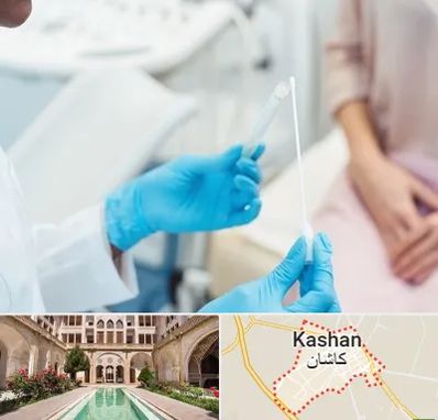 دکتر زگیل تناسلی HPV در کاشان