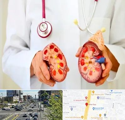 دکتر سنگ کلیه در ستاری 