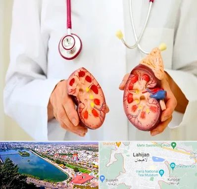 دکتر سنگ کلیه در لاهیجان